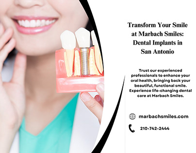 Dental Implants in San Antonio