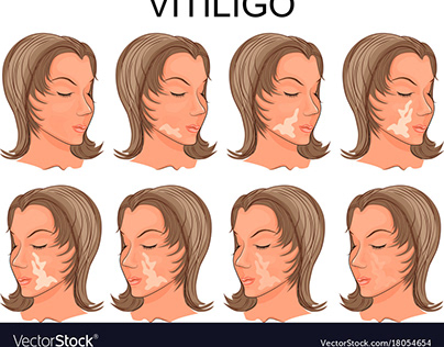 vitiligo starting stage