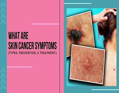 WHAT ARE SKIN CANCER SYMPTOMS
