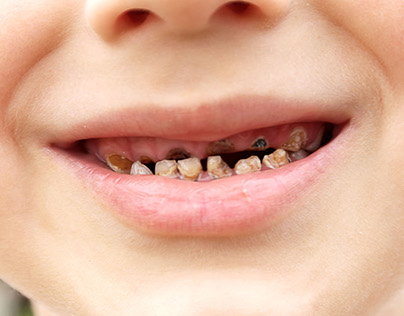 Thói quen sai lầm khiến răng sữa của trẻ bể nát