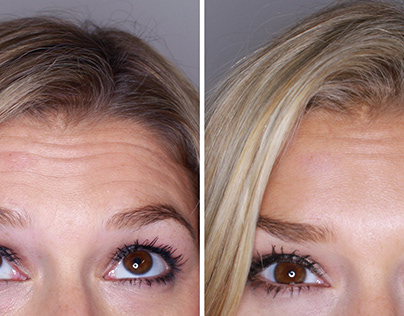 Botox before and after forehead
