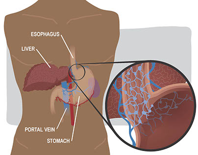 Medical Illustration: Stomach