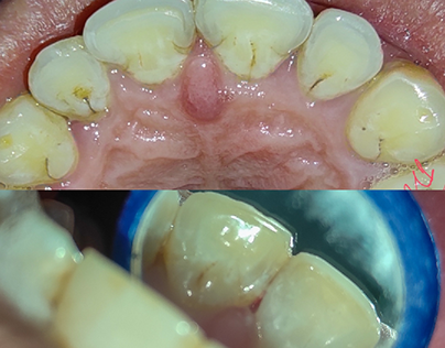 class III Composite restoration tooth no.11