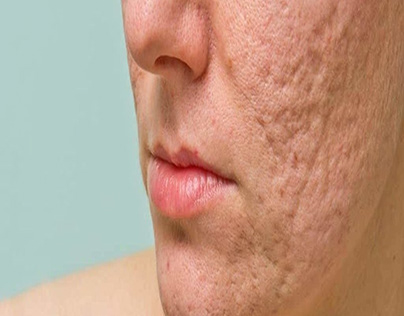 skin acne scar Treatment in Delhi