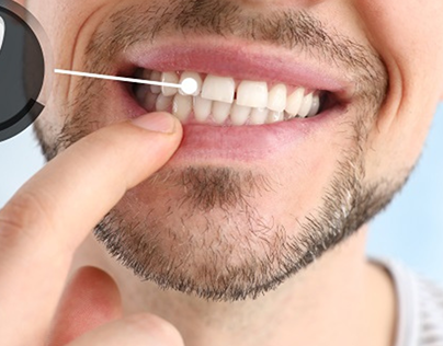 Exploring Full Jaw Dental Implants