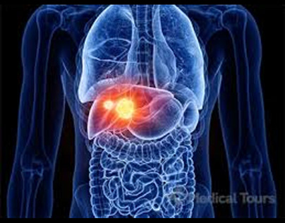 Best Liver Cancer Treatment in India