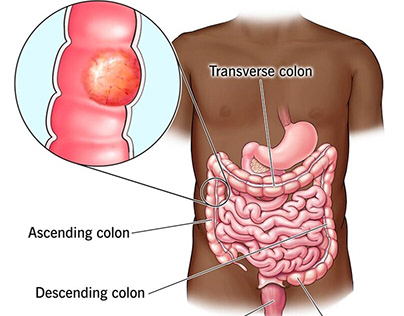 Dr. Chintamani : Colorectal Cancer Treatment in India