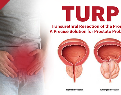 TURP - A PRECISE SOLUTION FOR PROSTATE PROBLEMS