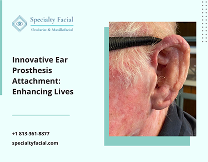 Innovative Ear Prosthesis Attachment Enhancing Lives