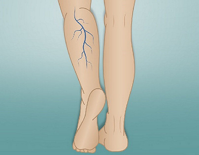 Medical Arrow: Leading Solutions for Varicose Veins