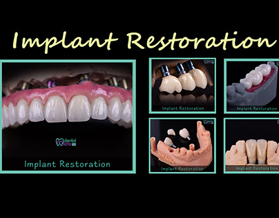 Dental Implant Restorations Project