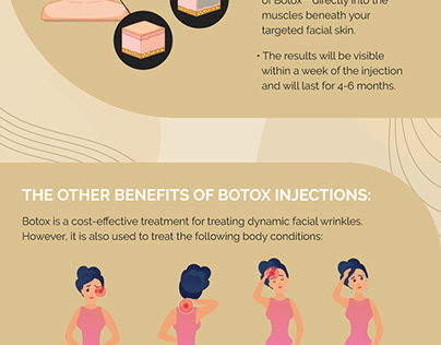 Benefits of Botox Injections