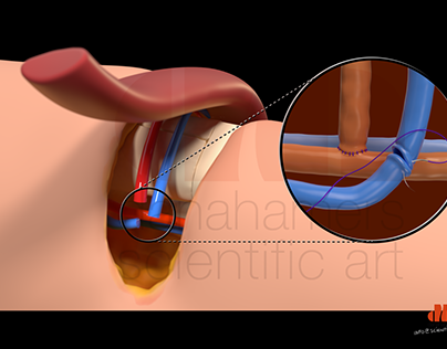 Open fracture trauma Gracilis operation (3D)