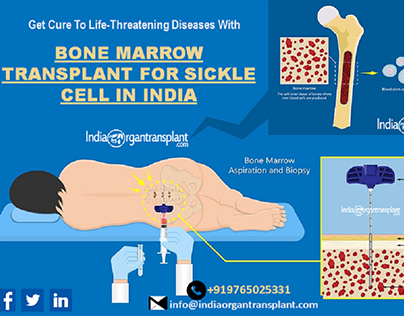 Bone Marrow Transplant for Sickle Cell in India
