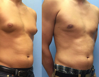 Things Related To Gynecomastia Surgery