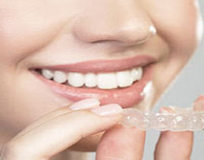 What is the cost of Braces treatment