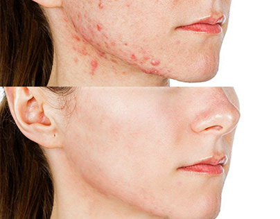 Image retouching / Clear acne and blemishes