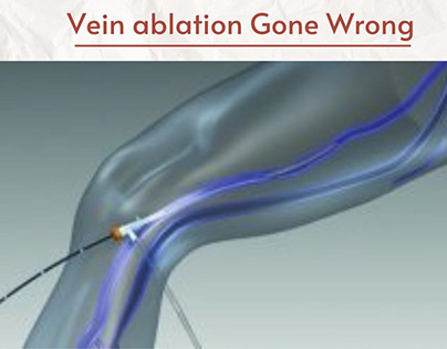 Vein Ablation Went Wrong