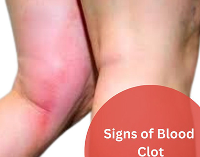 BLOOD CLOTS AFTER VEIN ABLATION