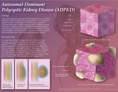 Histology & Histopathology of ADPKD