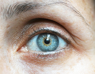 Understanding Treating Choroidal Melanoma of the Eye