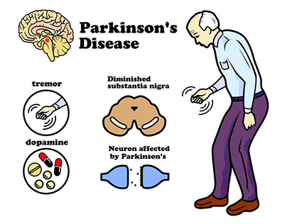Parkinson’s Disease Epidemiology Study