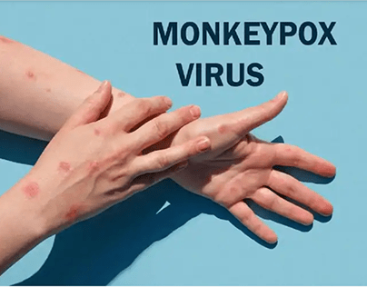 In Vitro Diagnostic Challenges in Monkeypox Outbreak