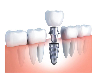 Trồng răng Implant giá bao nhiêu một cái?