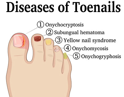 permanent toenail removal pros and cons