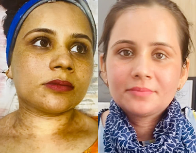 Best Skin Dermatologist in chandigarh