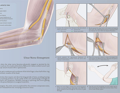 Surgery: Carpal Tunnel Release and Ulnar Nerve Release