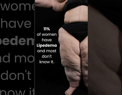 Lipedema Types and Stages