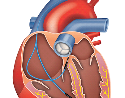 Pacemaker lead placement