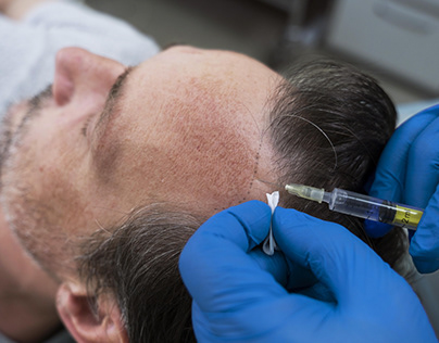plasma therapy for hair loss in jaipur