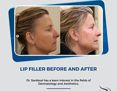 Lip Filler Before And After - Balwin Aesthetics