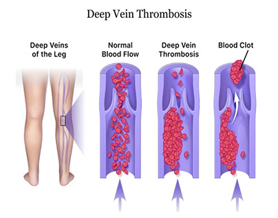 Deep Vein Thrombosis Treatment in Mumbai