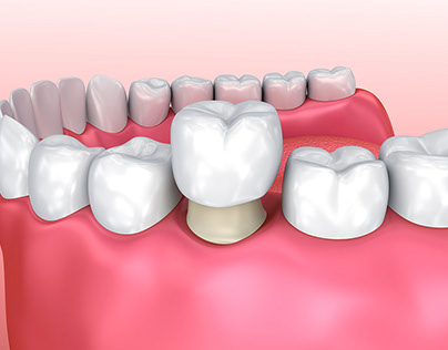 Top Notch Dental Crown Procedure