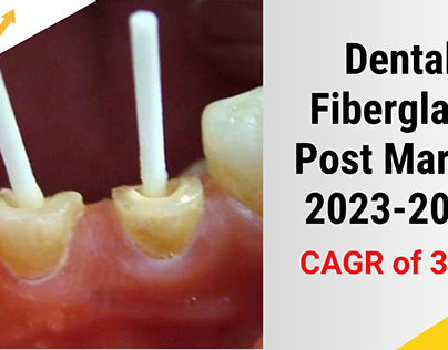 Dental Fiberglass Post Market 2023