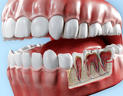 Project thumbnail - 3D Teeth and tooth decay cross section
