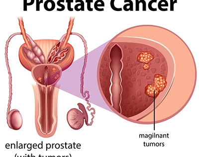 Advanced Prostate Cancer Care: Diagnosis and Treatment