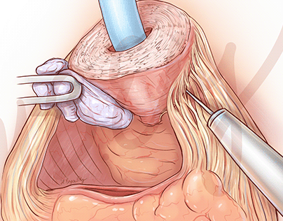 Prostatectomy with hydrodissection