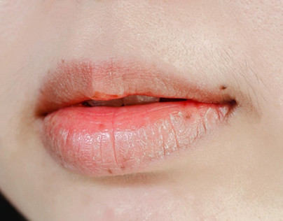 6 Home remedies for dry, chapped and cracked lips
