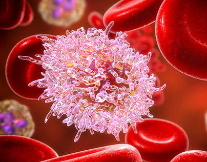 Leucemia: ¿Qué es y cómo se clasifican?