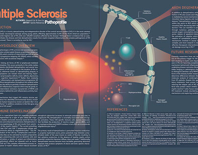 Multiple Sclerosis Pathoprofile