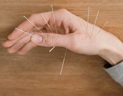 Acupuncture Therapy Sherwood Park