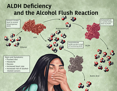 ALDH Deficiency and the Alcohol Flush Reaction