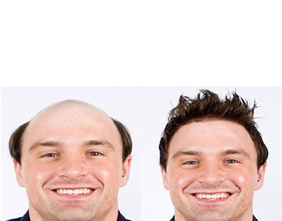 Mens Hair Pieces Before and After