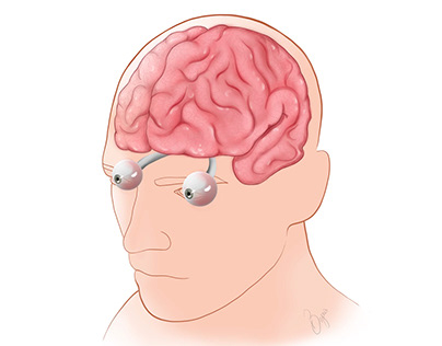 Brain with Optic nerves