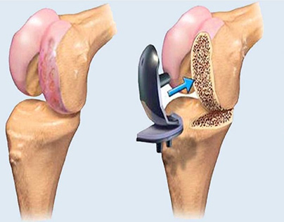 Joint Replacement Surgery - Rajeshwar Hospital