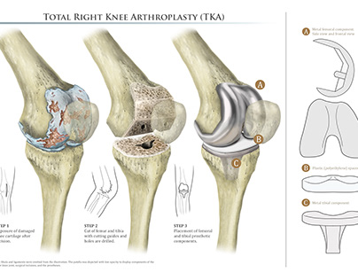 Total right knee arthroplasty (TKA).